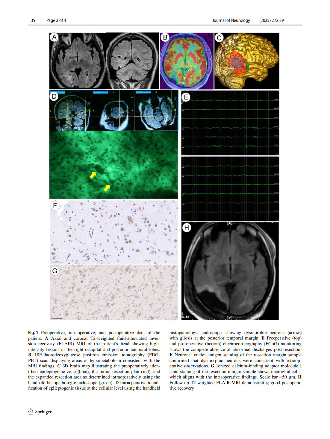 Intraoperative identifcation of epileptogenic foci using handheld  histopathologic endoscopy: a case report(圖2)