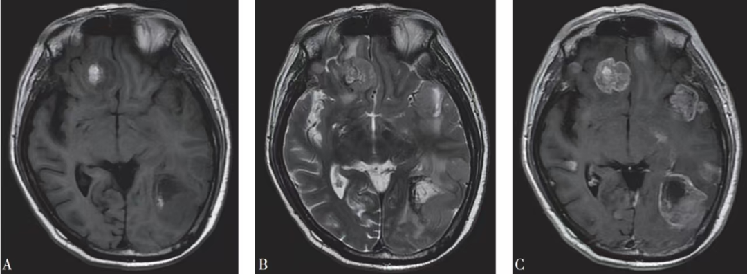 EndoScell?術(shù)中手持顯微鏡助力腦轉(zhuǎn)移瘤細(xì)胞級精準(zhǔn)手術(shù)，最大化安全切除(圖4)