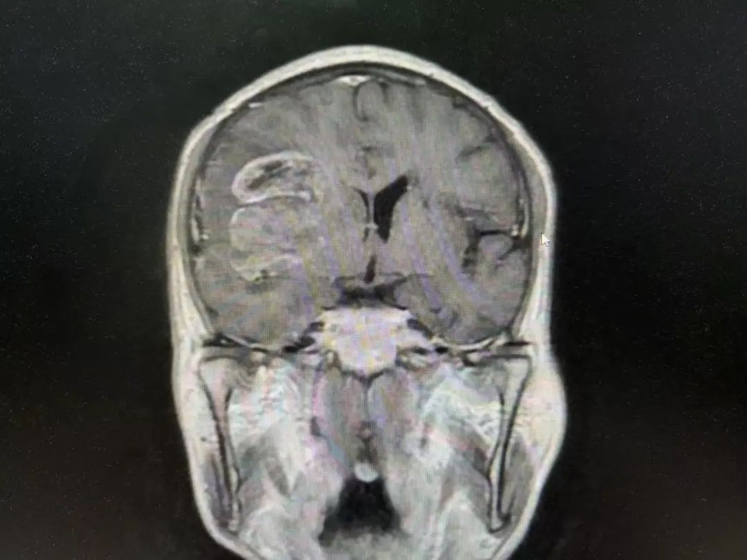 河北醫(yī)大二院應(yīng)用細(xì)胞級熒光導(dǎo)引精準(zhǔn)技術(shù)，突破高級別膠質(zhì)瘤手術(shù)的裸眼限制(圖5)