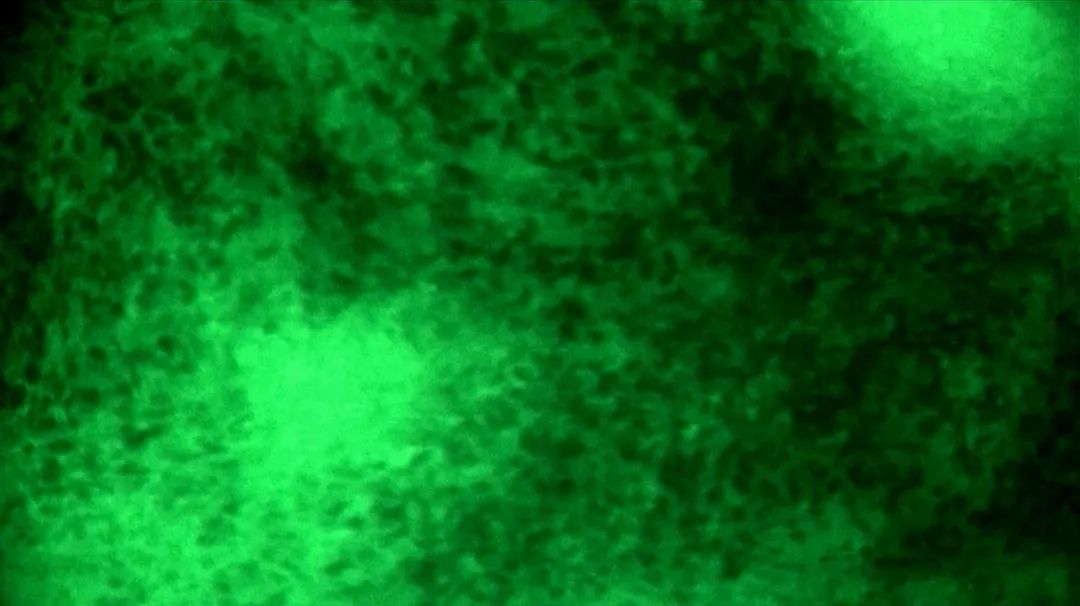 河北醫(yī)大二院應(yīng)用細(xì)胞級熒光導(dǎo)引精準(zhǔn)技術(shù)，突破高級別膠質(zhì)瘤手術(shù)的裸眼限制(圖9)