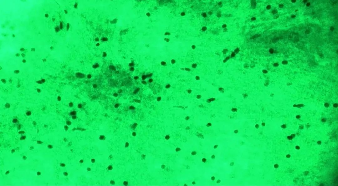 河北醫(yī)大二院應(yīng)用細(xì)胞級熒光導(dǎo)引精準(zhǔn)技術(shù)，突破高級別膠質(zhì)瘤手術(shù)的裸眼限制(圖10)