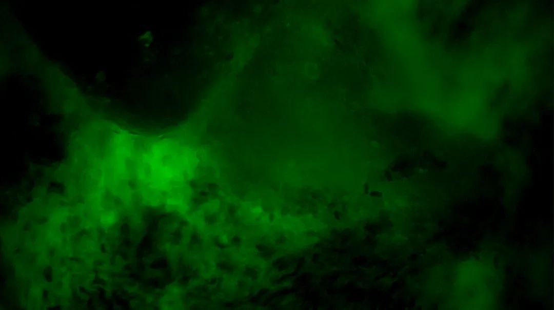 齊魯醫(yī)院開啟精準(zhǔn)手術(shù)新篇章，細(xì)胞級熒光導(dǎo)引技術(shù)助力腦膠質(zhì)瘤最大化安全切除(圖5)