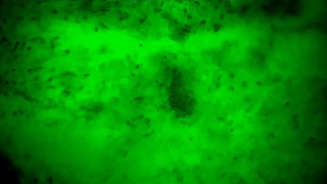 齊魯醫(yī)院開啟精準(zhǔn)手術(shù)新篇章，細(xì)胞級(jí)熒光導(dǎo)引技術(shù)助力腦膠質(zhì)瘤最大化安全切除(圖6)