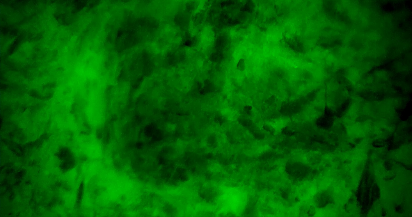 國內首例！齊魯醫(yī)院應用細胞級顯微鏡同步術中快速分子病理診斷指導膠質瘤精準切除(圖3)