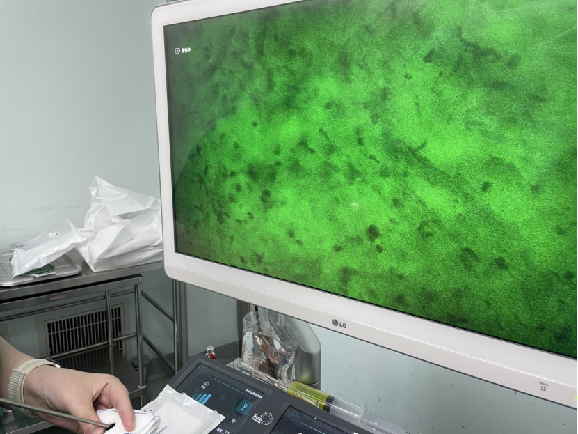 國內(nèi)首例！齊魯醫(yī)院應用細胞級顯微鏡同步術中快速分子病理診斷指導膠質瘤精準切除(圖2)