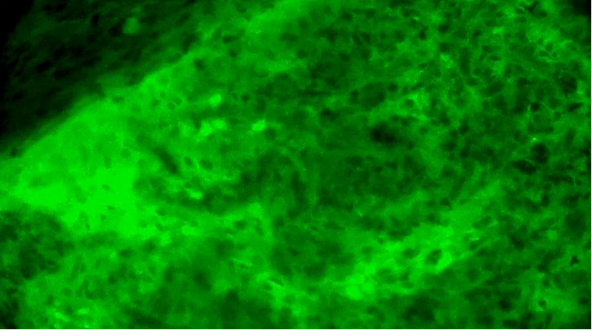 膠質(zhì)母細(xì)胞瘤手術(shù)新突破:河北醫(yī)大二院應(yīng)用EndoSCell?實(shí)現(xiàn)細(xì)胞級精準(zhǔn)切除(圖4)