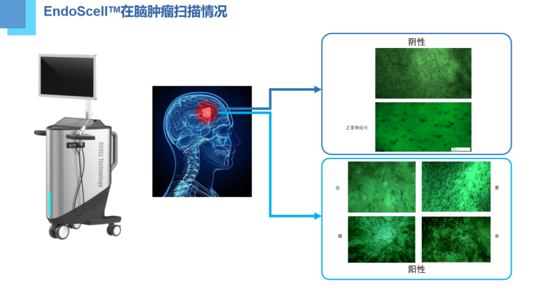 第八屆華福神經(jīng)外科學(xué)術(shù)會(huì)議：EndoSCell?細(xì)胞級(jí)熒光導(dǎo)引技術(shù)獲專家認(rèn)可(圖3)