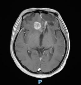 天津首例！天津市環(huán)湖醫(yī)院應(yīng)用細(xì)胞級熒光導(dǎo)引技術(shù)精準(zhǔn)切除高級別膠質(zhì)瘤(圖3)