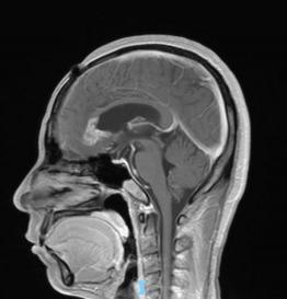 天津首例！天津市環(huán)湖醫(yī)院應(yīng)用細(xì)胞級熒光導(dǎo)引技術(shù)精準(zhǔn)切除高級別膠質(zhì)瘤(圖6)