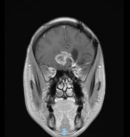 天津首例！天津市環(huán)湖醫(yī)院應(yīng)用細(xì)胞級熒光導(dǎo)引技術(shù)精準(zhǔn)切除高級別膠質(zhì)瘤(圖5)