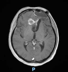 天津首例！天津市環(huán)湖醫(yī)院應(yīng)用細(xì)胞級(jí)熒光導(dǎo)引技術(shù)精準(zhǔn)切除高級(jí)別膠質(zhì)瘤(圖4)