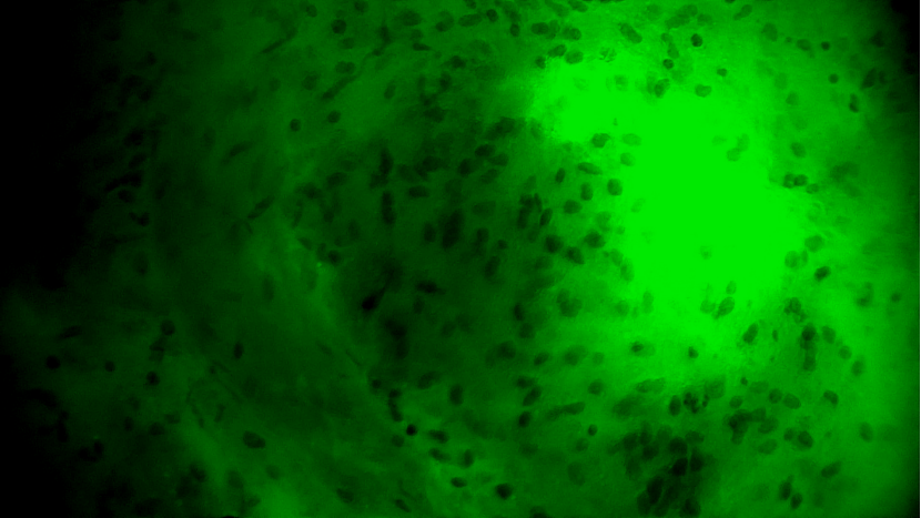 天津首例！天津市環(huán)湖醫(yī)院應(yīng)用細(xì)胞級(jí)熒光導(dǎo)引技術(shù)精準(zhǔn)切除高級(jí)別膠質(zhì)瘤(圖7)