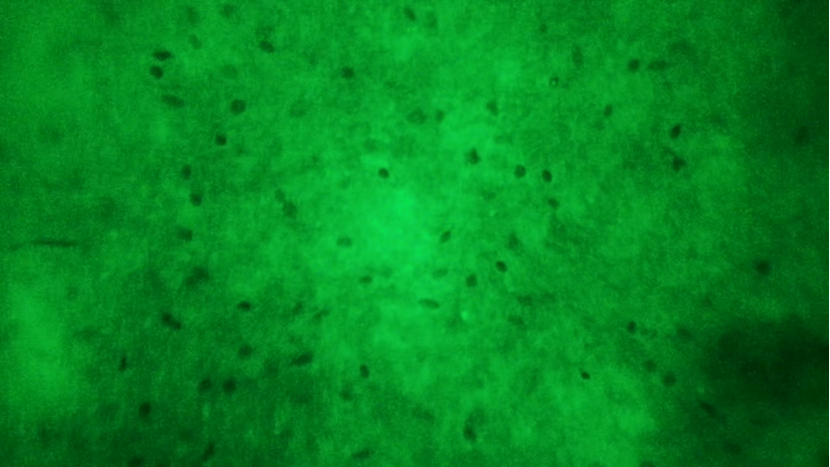 天津首例！天津市環(huán)湖醫(yī)院應(yīng)用細(xì)胞級(jí)熒光導(dǎo)引技術(shù)精準(zhǔn)切除高級(jí)別膠質(zhì)瘤(圖9)