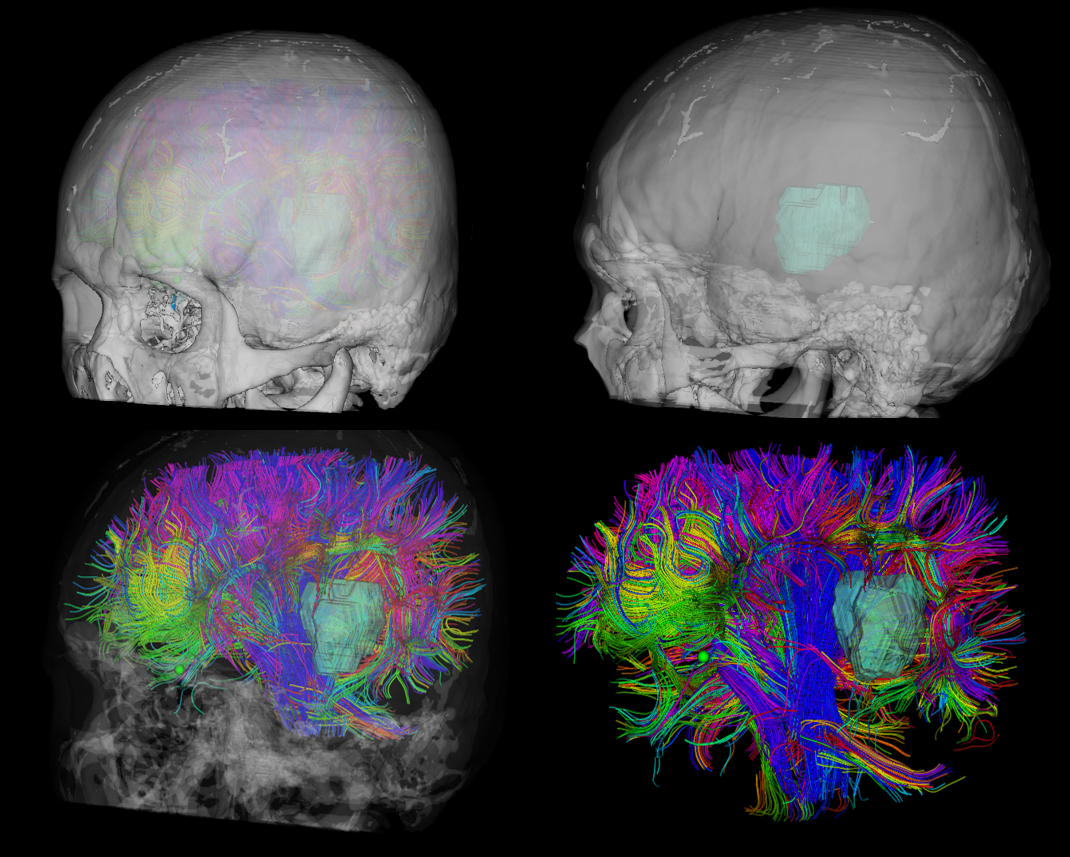 這項新技術(shù)加持，南方醫(yī)科大學珠江醫(yī)院專家“細胞級切除”微小腫瘤(圖2)