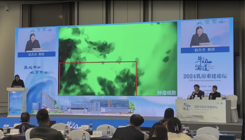 杭州乳房重建論壇:細胞級熒光導(dǎo)引技術(shù)EndoSCell?為保乳術(shù)精準(zhǔn)切除保駕護航(圖4)