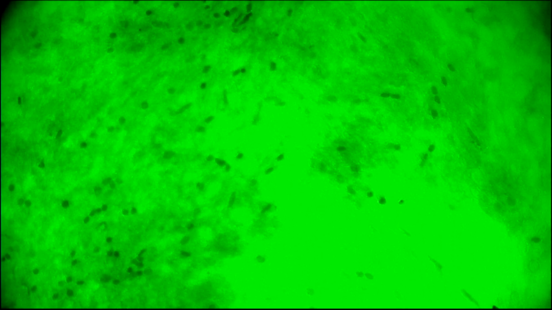 細(xì)胞級精準(zhǔn)切除！河北醫(yī)大二院應(yīng)用EndoSCell?實現(xiàn)膠質(zhì)瘤手術(shù)新突破(圖9)