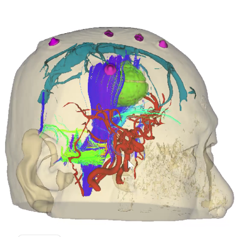細(xì)胞級精準(zhǔn)切除！河北醫(yī)大二院應(yīng)用EndoSCell?實現(xiàn)膠質(zhì)瘤手術(shù)新突破(圖5)