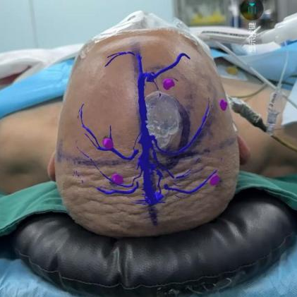 細(xì)胞級精準(zhǔn)切除！河北醫(yī)大二院應(yīng)用EndoSCell?實現(xiàn)膠質(zhì)瘤手術(shù)新突破(圖6)