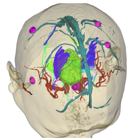 細胞級精準切除！河北醫(yī)大二院應用EndoSCell?實現膠質瘤手術新突破(圖4)