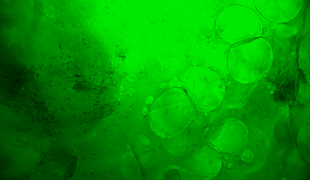 中國科大附一院開啟乳腺癌治療新篇章:細胞級熒光導引技術(shù)助力精準保乳術(shù)(圖4)