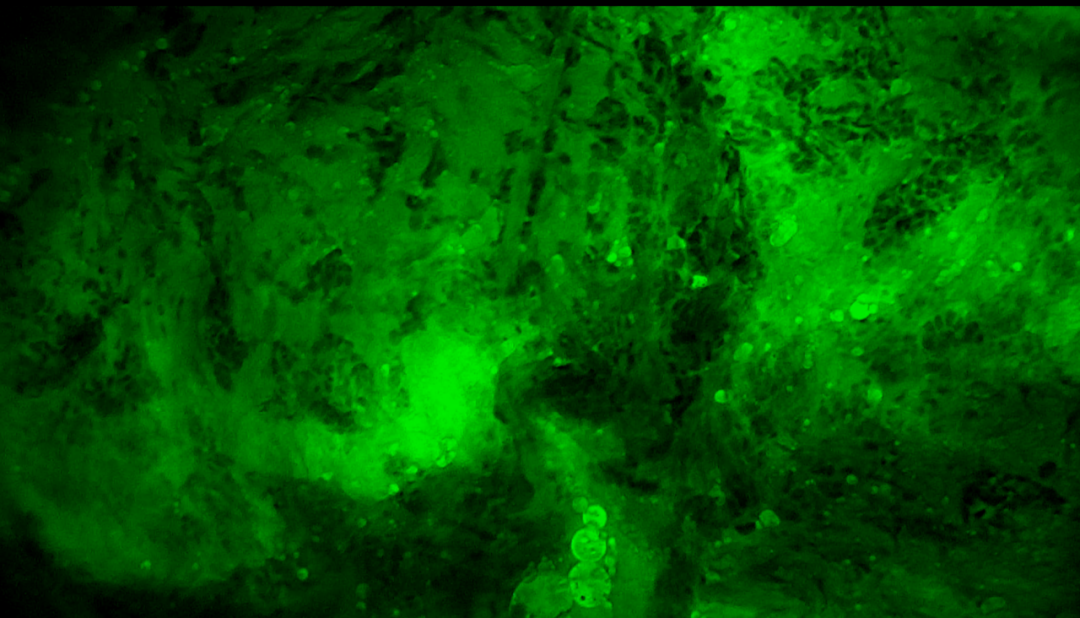 中國科大附一院開啟乳腺癌治療新篇章：細胞級熒光導引技術助力精準保乳術(圖3)