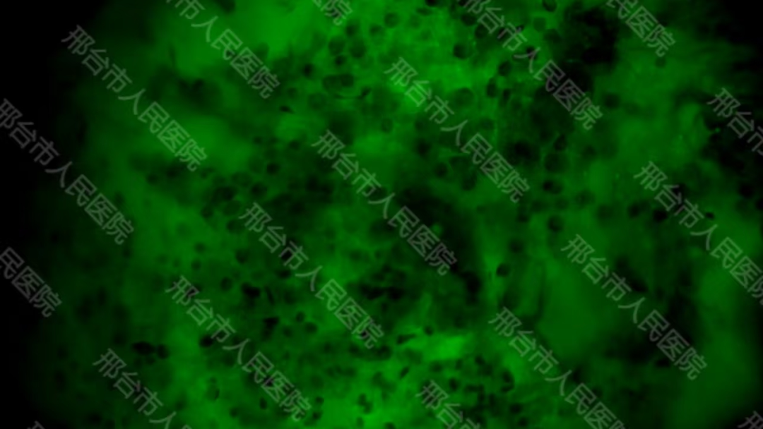 腦惡性腫瘤手術(shù)治療新進(jìn)展！邢臺(tái)市人民醫(yī)院應(yīng)用術(shù)中細(xì)胞級(jí)熒光導(dǎo)引技術(shù)最大化安全切除腦膠質(zhì)瘤(圖3)