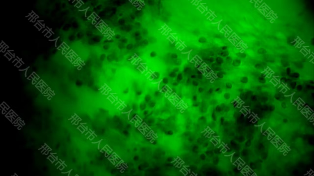 腦惡性腫瘤手術(shù)治療新進(jìn)展！邢臺(tái)市人民醫(yī)院應(yīng)用術(shù)中細(xì)胞級(jí)熒光導(dǎo)引技術(shù)最大化安全切除腦膠質(zhì)瘤(圖4)