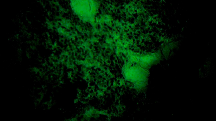 甲狀腺癌手術(shù)新突破！河北省人民醫(yī)院成功應(yīng)用細(xì)胞級熒光導(dǎo)引技術(shù)實(shí)現(xiàn)精準(zhǔn)切除與保功能(圖3)