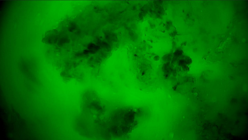 甲狀腺癌手術(shù)新突破！河北省人民醫(yī)院成功應(yīng)用細(xì)胞級熒光導(dǎo)引技術(shù)實(shí)現(xiàn)精準(zhǔn)切除與保功能(圖5)