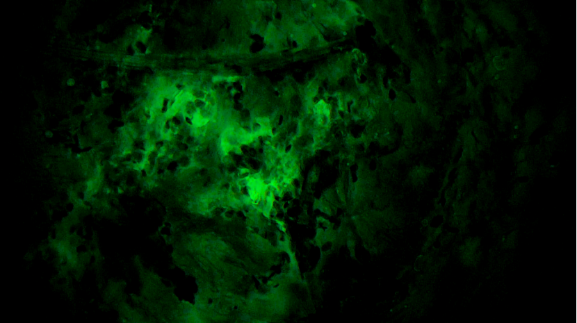 甲狀腺癌手術(shù)新突破！河北省人民醫(yī)院成功應(yīng)用細胞級熒光導引技術(shù)實現(xiàn)精準切除與保功能(圖6)